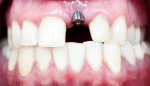 Dental implants are directly fused to the jawbone and provide unparalleled comfort and reliability.