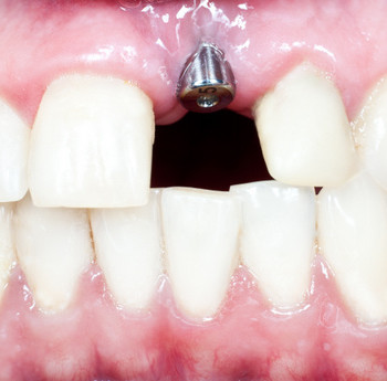 Dental implants are directly fused to the jawbone and provide unparalleled comfort and reliability.