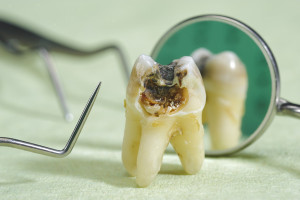 Our San Jose, CA area patients know that it is important to pursue treatment with dental implants as soon as possible.