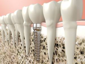 Our San Jose, CA patients know that dental implants make a better treatment for missing teeth than dentures.