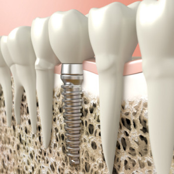 Our San Jose, CA patients know that dental implants make a better treatment for missing teeth than dentures.