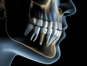 Dental implants can help diabetics manage blood sugar levels.