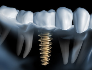 Image of dental implant