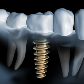 Image of dental implant