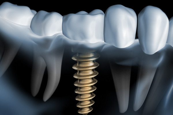 Image of dental implant