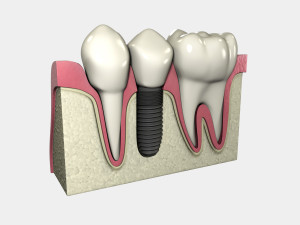 peri-implantitis id bacterial disease occurring ion dental implant patients.