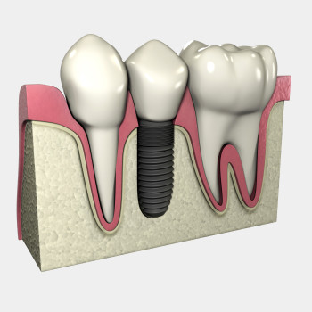 peri-implantitis id bacterial disease occurring ion dental implant patients.