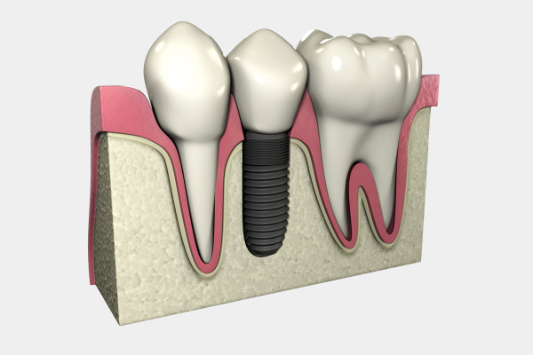 peri-implantitis id bacterial disease occurring ion dental implant patients.