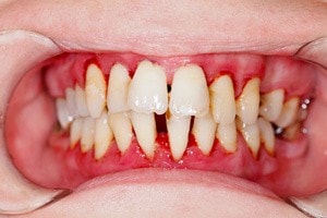 Avoid periodontitis with proper gum care